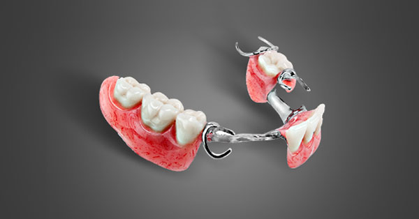 5 Benefits of Partial Dentures