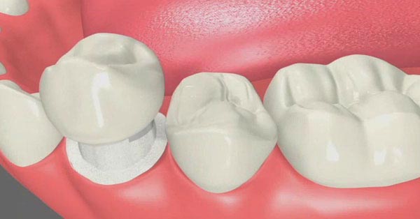 Dental Crowns Play an Important Role in Dental Care