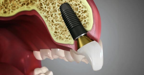 Dental Implants: Why They are the Gold Standard for Replacing Missing Teeth