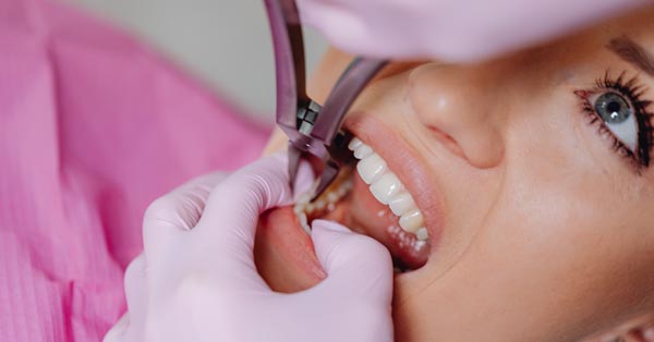 Do You Have to Get Your Wisdom Teeth Removed?