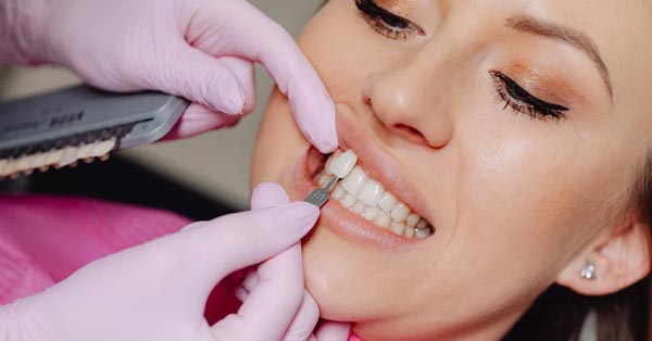 Got a Gummy Smile? Just One of Many Reasons to Consider Veneers