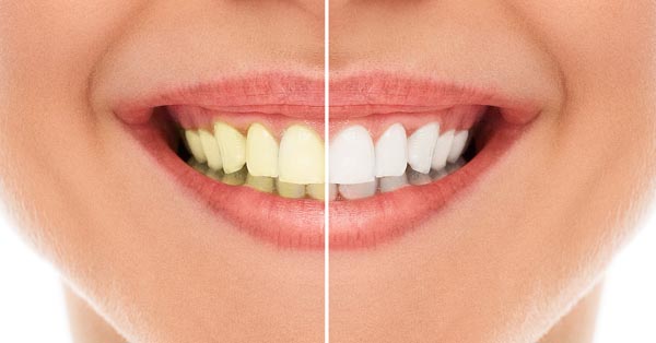 How Zoom!® Works to Whiten Your Teeth