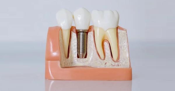 Non-Cosmetic Reasons to Consider Dental Implants