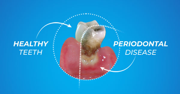 Periodontal Disease Q&A