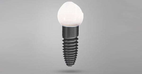 Why Dental Implants Continue to Rise Above Other Replacement Options
