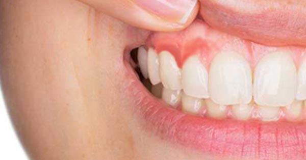 Why Pinhole Surgery Might Be the Answer to Your Periodontal Disease